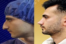 عمل بینی اقساطی در کلینیک زیبایی نورسا؛ ترکیب کیفیت و انعطاف مالی