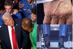 کبودی‌های روی دست ترامپ ناشی از آسپرین و دست‌دادن‌های مکرر است