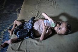 سوء تغذیه حاد در میان کودکان غزه به بالاترین سطح خود رسید