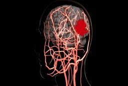 جدیدترین دستورالعمل‌ها برای کاهش خطر سکته مغزی