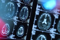 هوش مصنوعی به کمک تشخیص سکته مغزی آمد