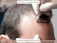 کاشت مو به روش DHI ؛ جدیدترین تکنیک کاشت مو طبیعی بدون تیغ و بخیه